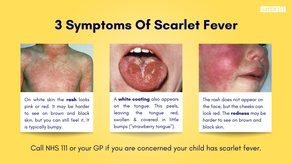 Can You Get Scarlet Fever Twice Nhs