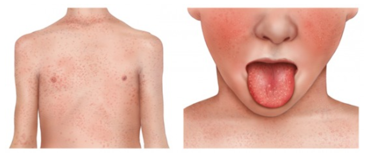 Will Scarlet Fever Show On Strep Test