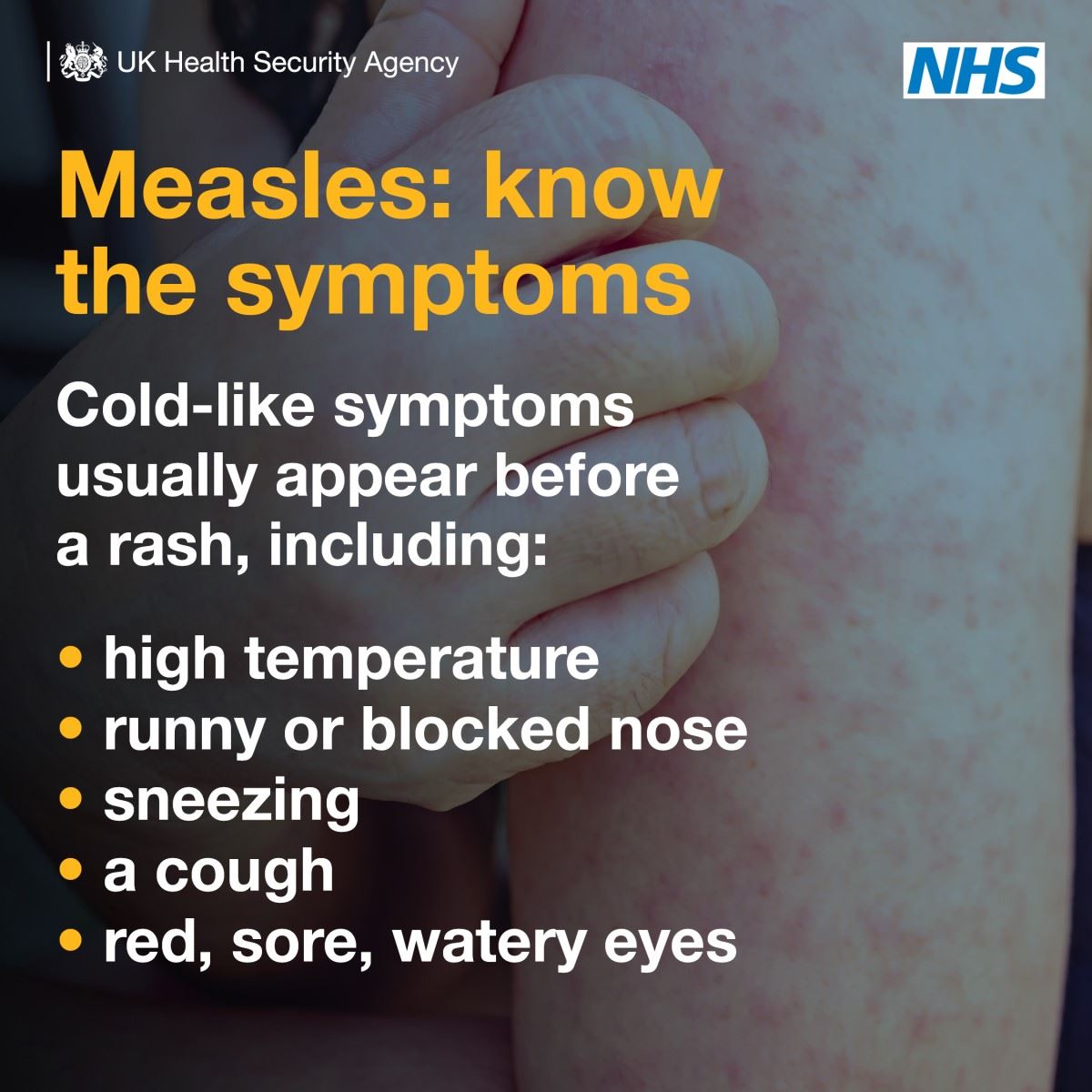 Measles: know the symptoms poster